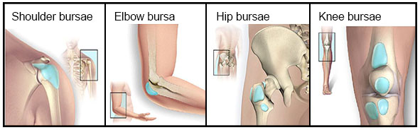 Bursitis